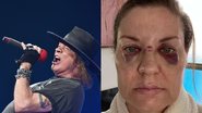 Axl Rose (Foto: Getty Images), Fã com hematomas (Foto: Reprodução / ABC News)