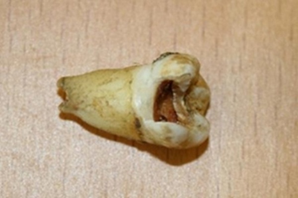 1 - Dente do John Lennon