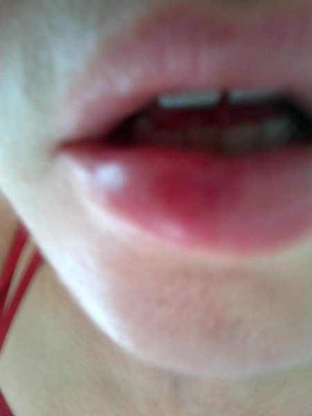 Madonna e seu ferimento no lábio